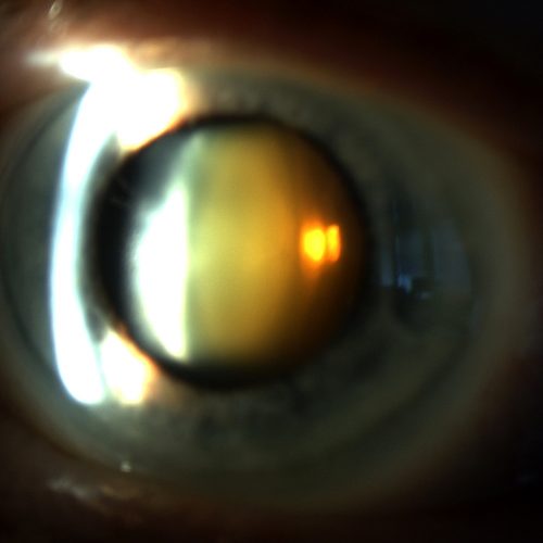 Cataracts