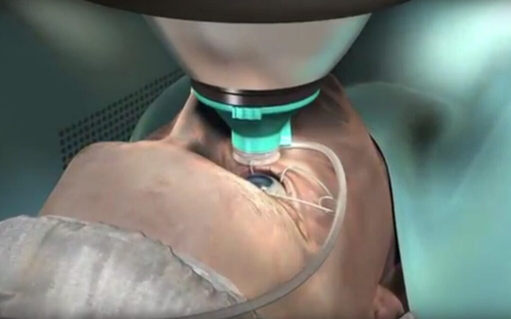 advanced cataract surgery with LenSx